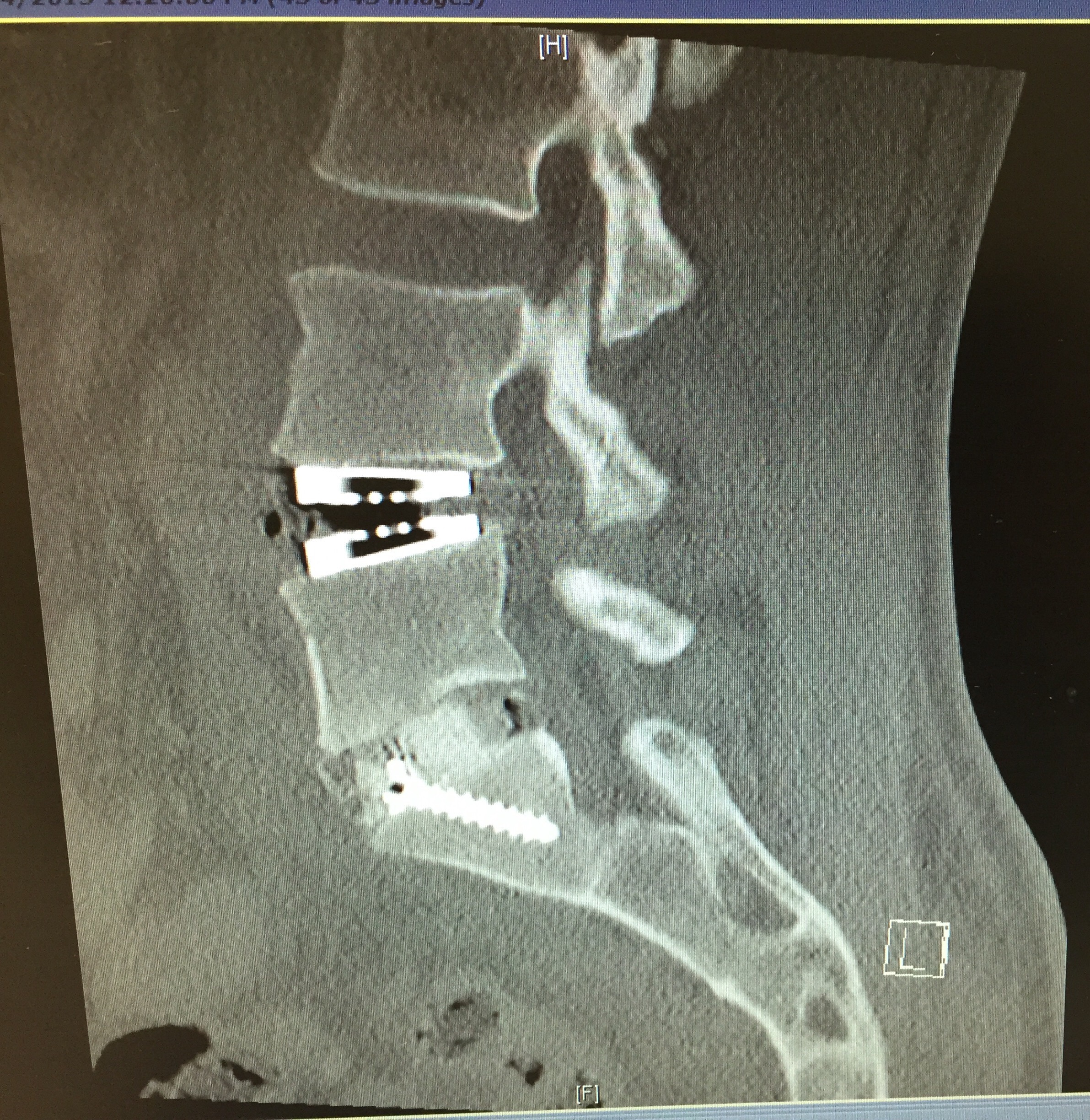 How long does it typically take for an L5-S1 herniated lumbar disc to heal?